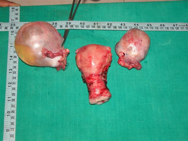 Bilatral ovarian cysts with uterus.JPG